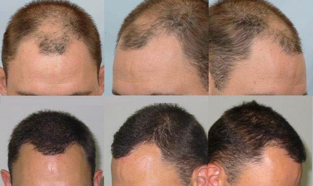 FUE hair transplant