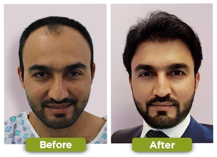 Best Hair Transplant in Karachi